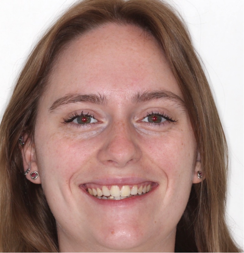 Adult Go Orthodontics patient