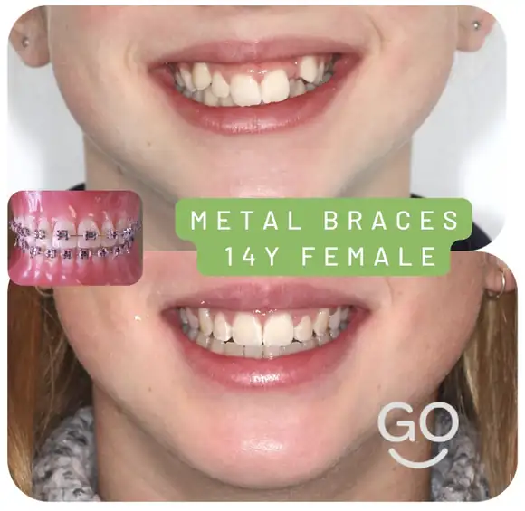 Before and after metal braces treatment result
